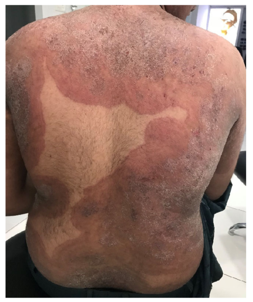 The back of a person with large patches of ringworm-like lesions.