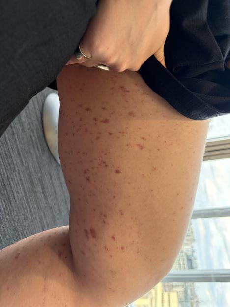 Image of a person's upper leg and lower torso with a red rash.