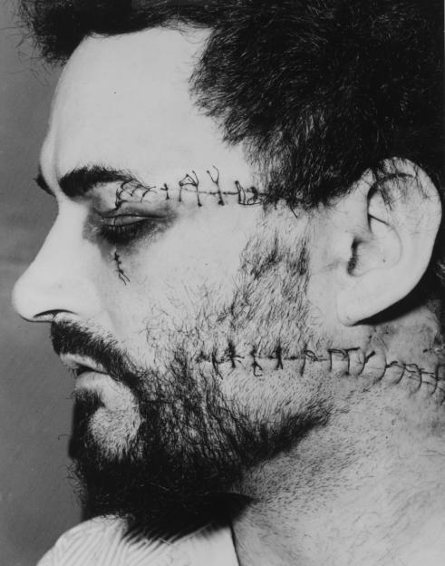 Peter Sutcliffe's face and neck are covered in stitches after being attacked by Costello with a coffee jar.