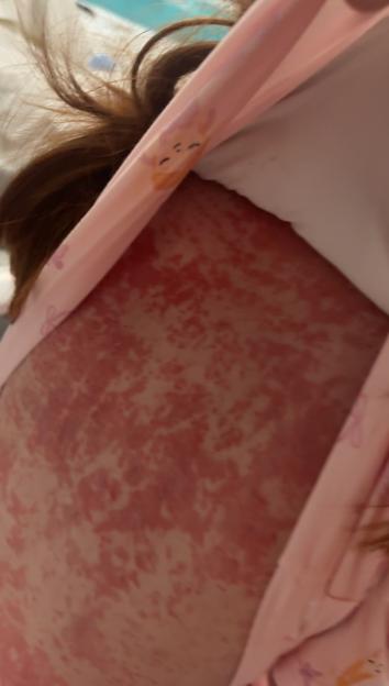 A close-up of a child's back covered in a large red rash.