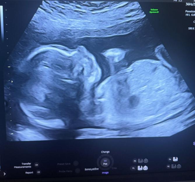 An ultrasound showing a fetal profile.