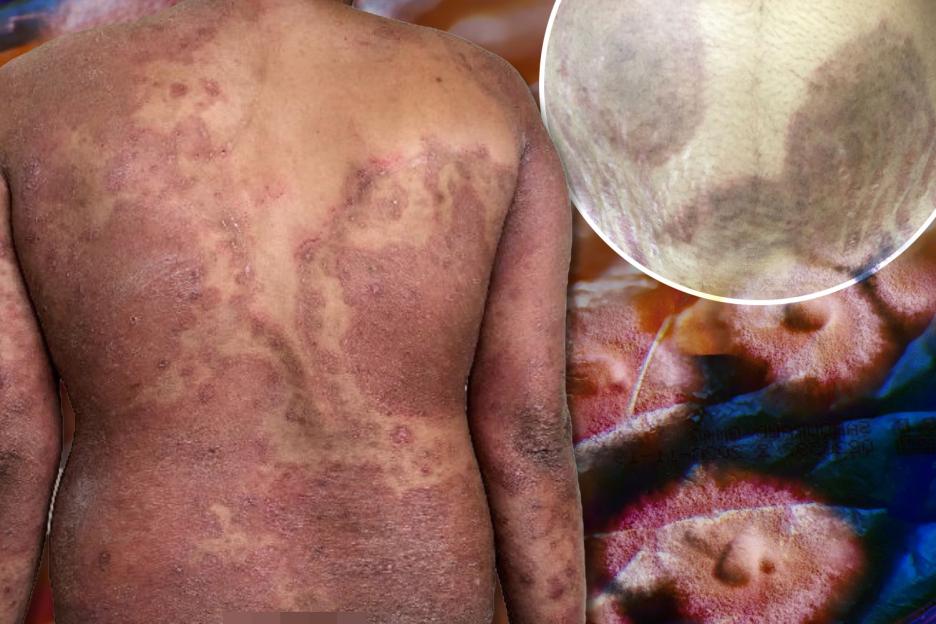 Drug-resistent ‘super fungus’ that attacks the groin and bum ‘spreading at PACE’ across UK, experts warn