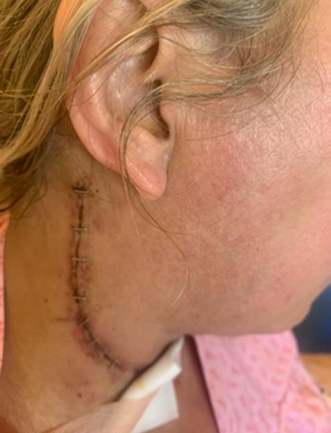 A close-up of Elaine Sawyer's neck after surgery, showing a vertical incision with surgical staples near her ear.
