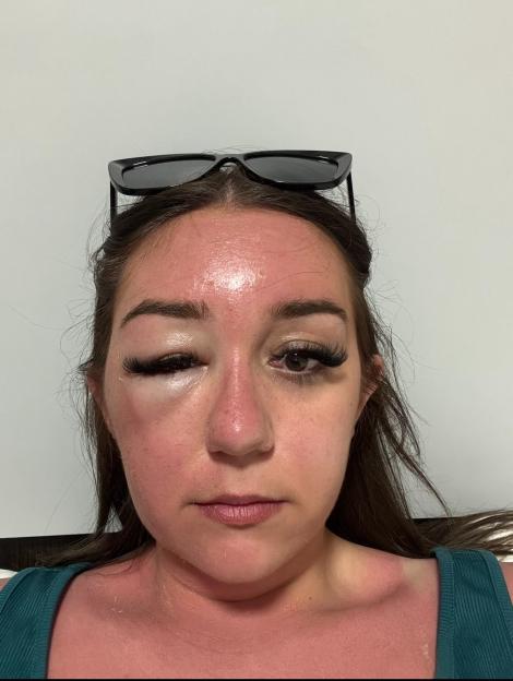 Holiday horror as Brit¿s ¿eye bags¿ lead to mystery illness ¿ trapping her in Greek hospital
