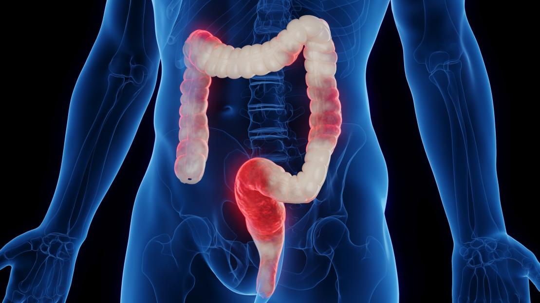 Inflamed colon, illustration