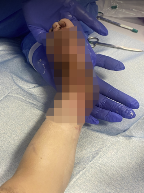 A burn injury on a baby's arm and hand.