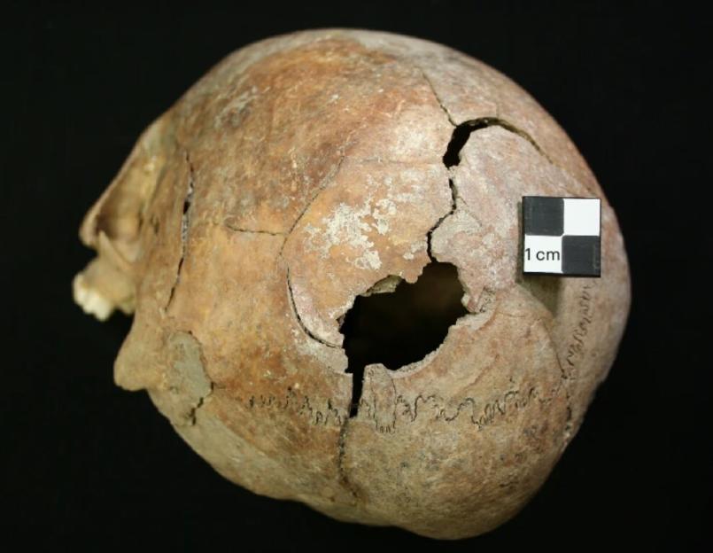 Ancient skull with a large bludgeoning injury and multiple cracks, next to a 1 cm scale.