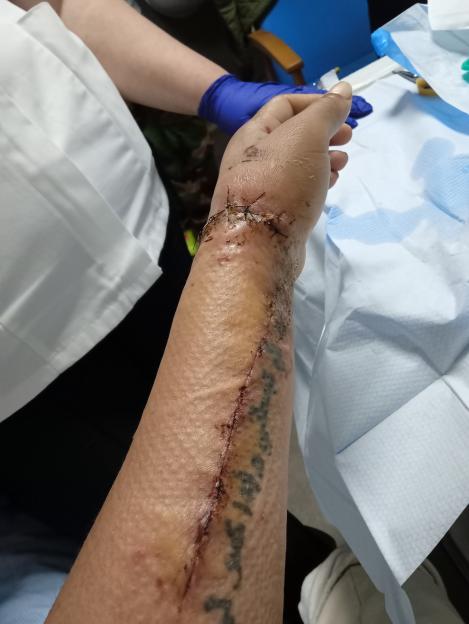 Arm with stitches and a long scar after being dragged by a train.