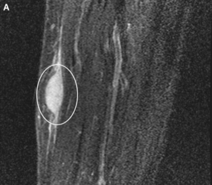 MRI scans showing a soft tissue sarcoma before regression in (A) a longitudinal view and (B) a cross-sectional view.