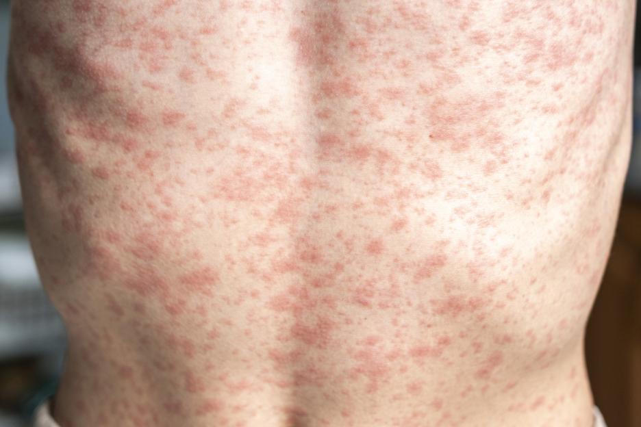 Person's back covered in measles rash.