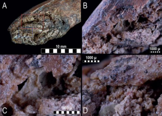 Collage of detailed views of bone fragments and lesions, with measurements.