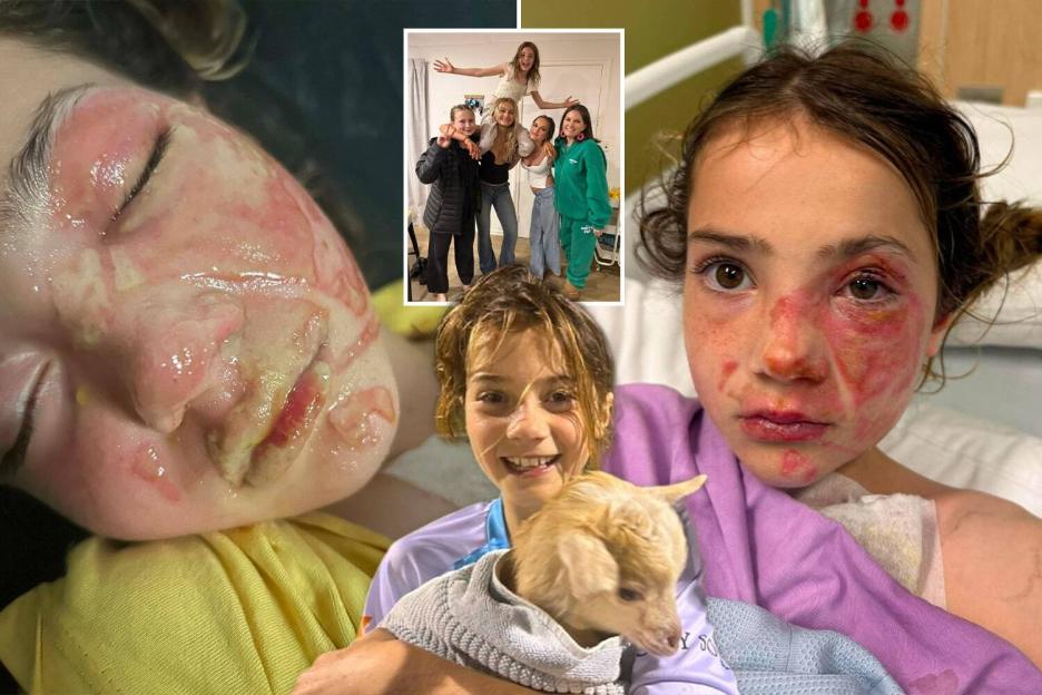 'Warning to Parents: My Daughter’s Skin Was Severely Burned After a Popular Squishy Toy Exploded!'