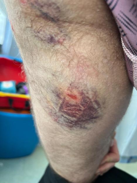 A person's leg with visible bite marks and bruising.