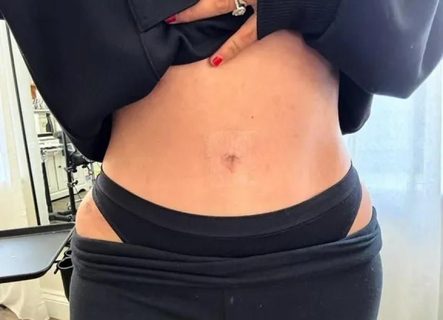 A person's abdomen showing a belly button after a cosmetic procedure.