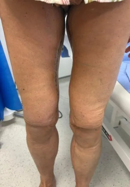 A person's legs showing loose skin and scarring after significant weight loss.